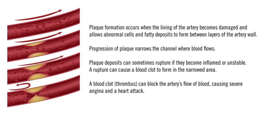 diagrams showing plaque formation and progression through arteries